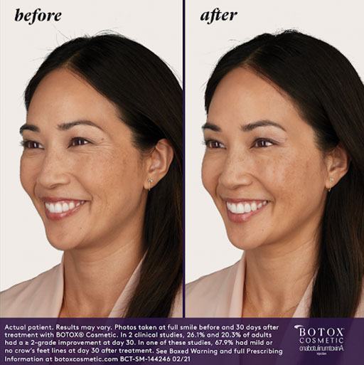 BOTOX Before & After | Injectables & Fillers
