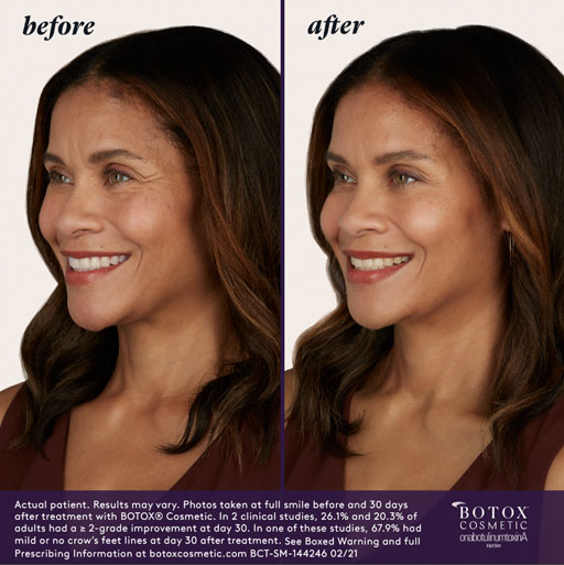 BOTOX Before & After | Injectables & Fillers