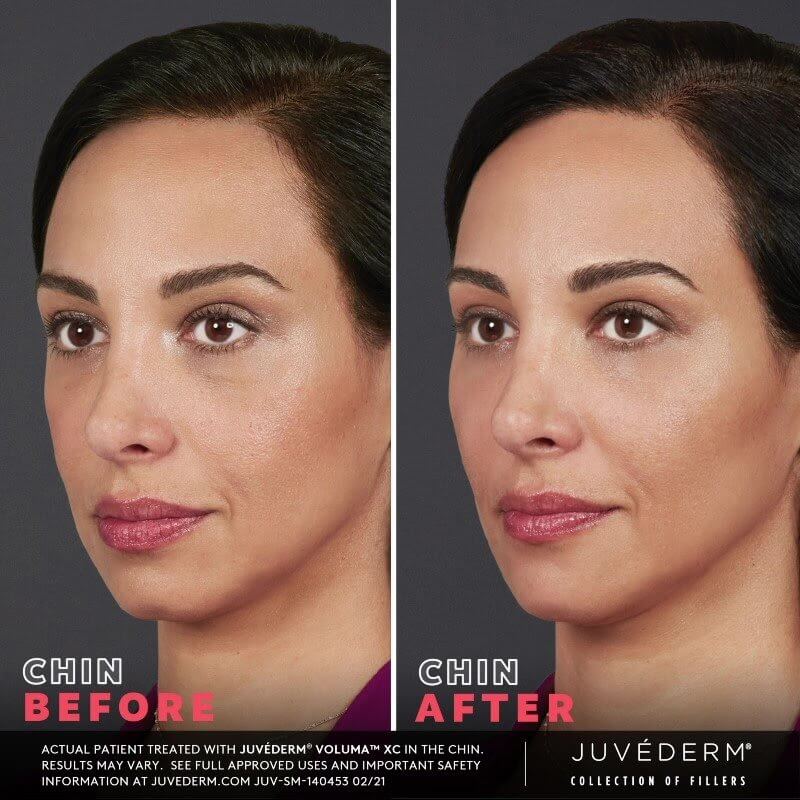 Juvederm Before & After | Injectables & Fillers