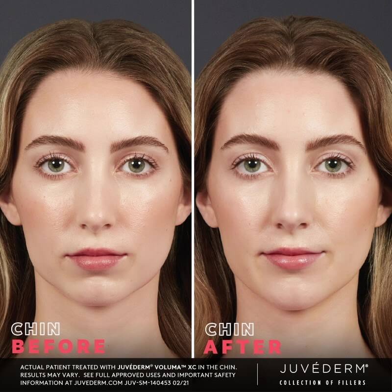 Juvederm Before & After | Injectables & Fillers