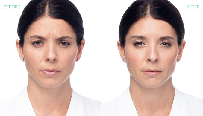 Dysport Before & After | Injectables & Fillers