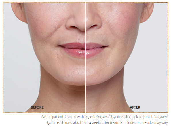 Restylane Before & After | Injectables & Fillers