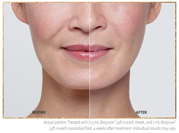 Restylane® Contour: A Natural-Looking HA Cheek Filler