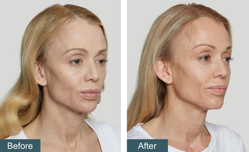 Sculptra Before & After | Injectables & Fillers