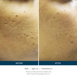 SkinPen Before & After | Face Treatments