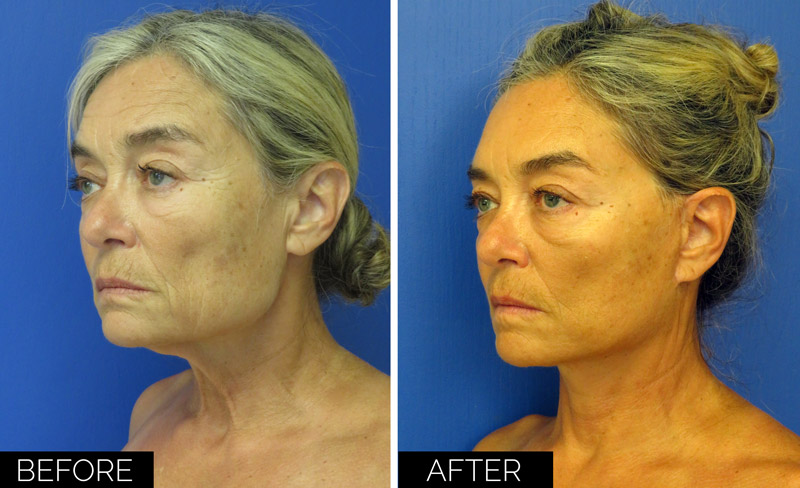 Before & After S-Lift Procedure